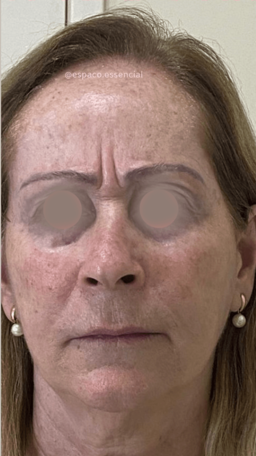 Bioestimulador de colágeno facial antes — estética avançada no Planalto, Belo Horizonte