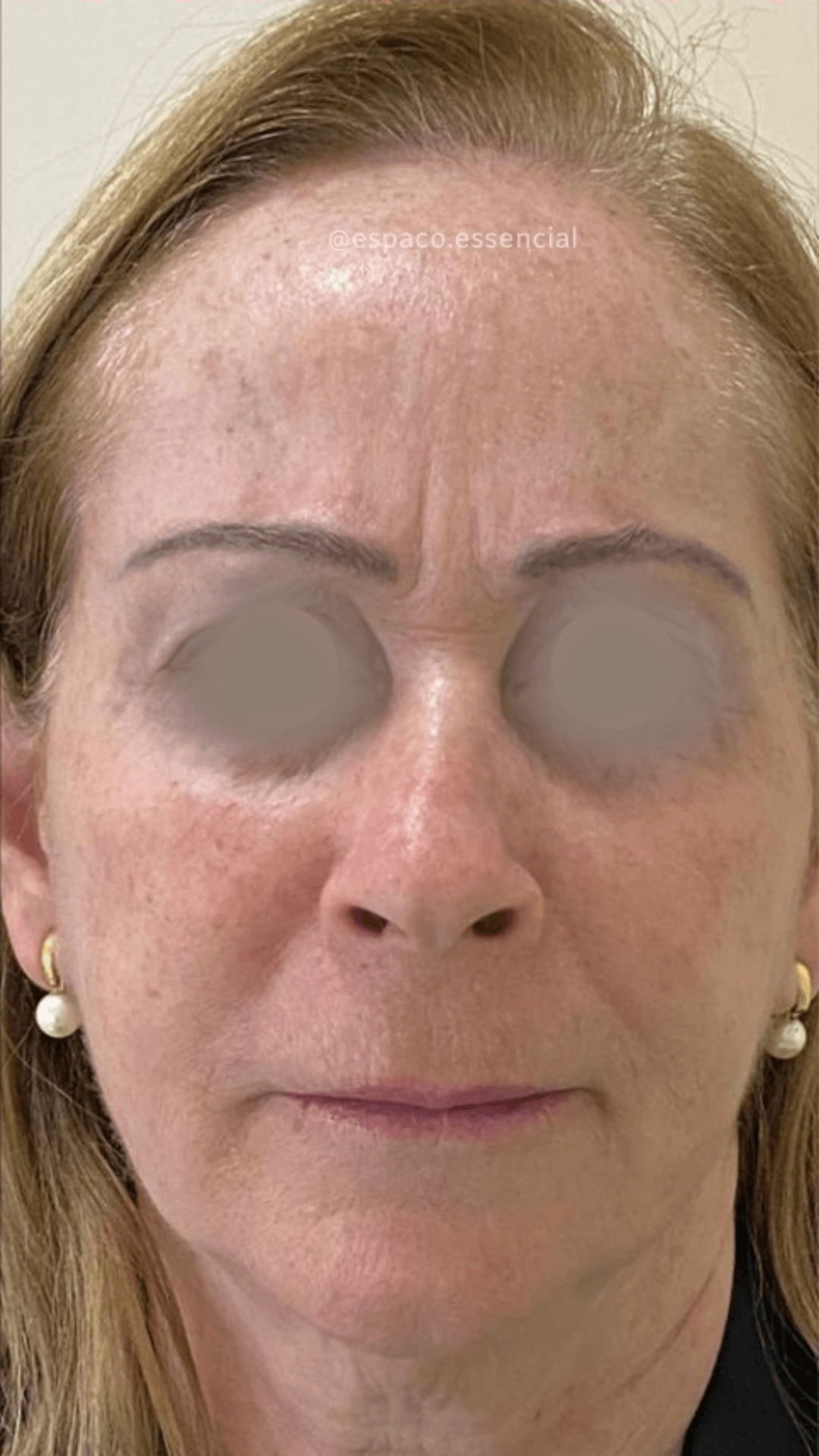 Bioestimulador de colágeno facial depois — resultado real de rejuvenescimento em BH