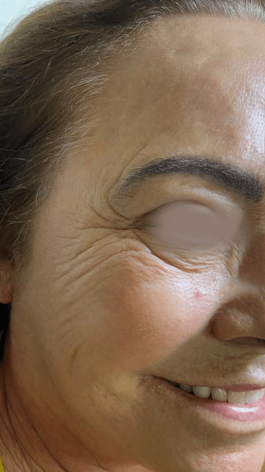 Toxina botulínica (botox) para rugas antes — estética facial no Planalto, Belo Horizonte