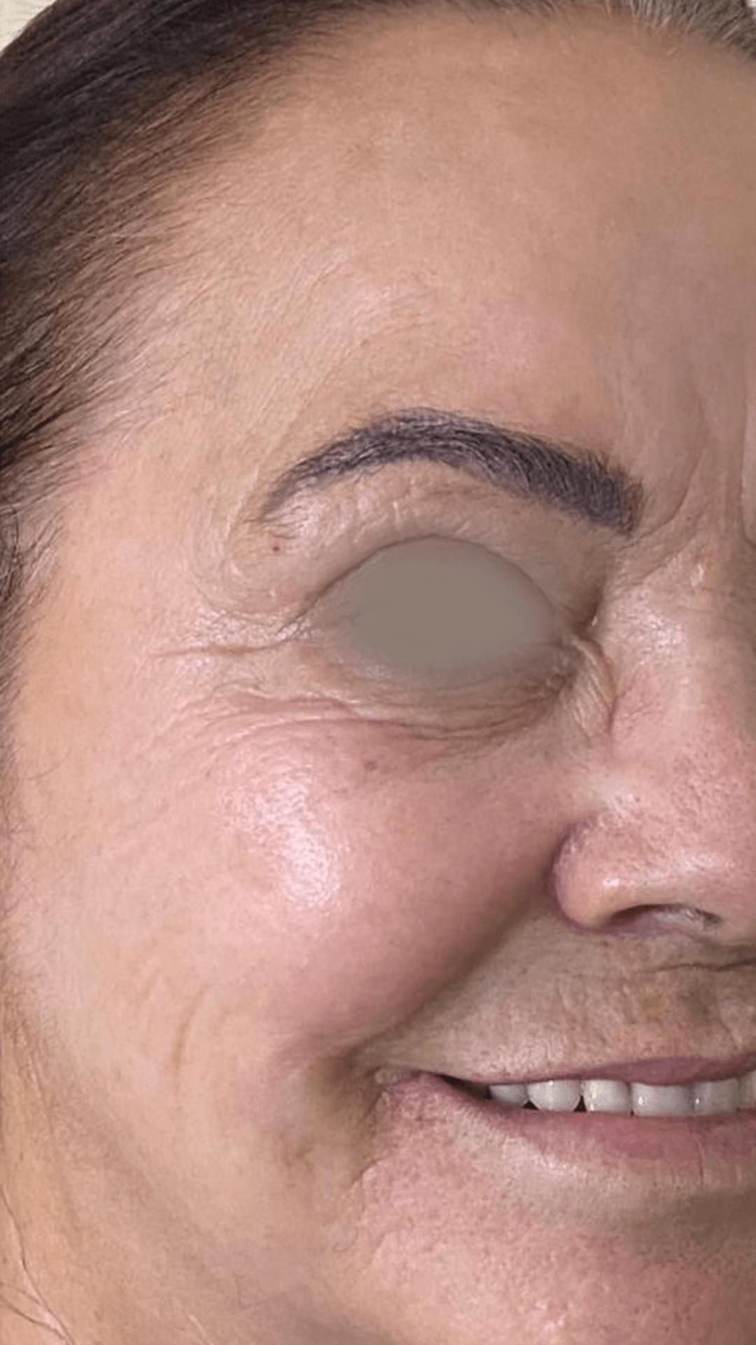 Toxina botulínica (botox) para rugas depois — pele lisa e rejuvenescida em BH