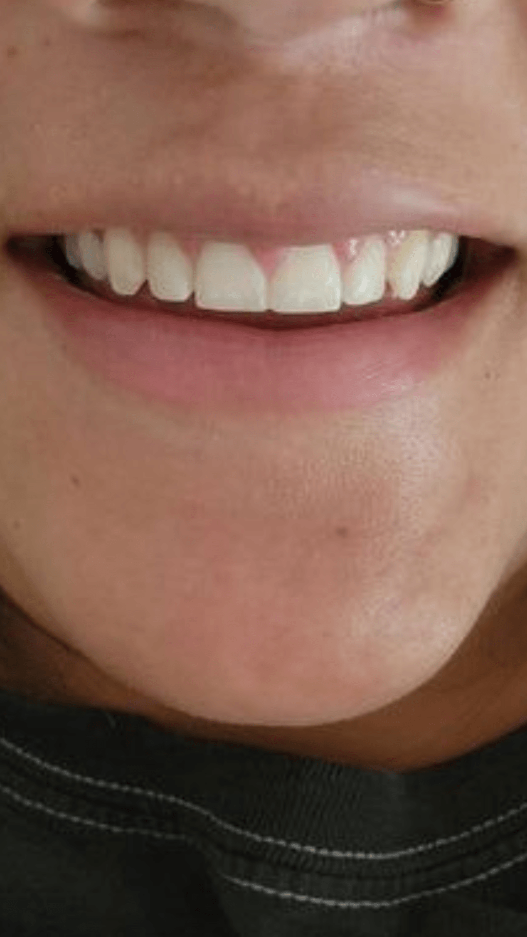 Clareamento dental antes dentes brancos Planalto Belo Horizonte