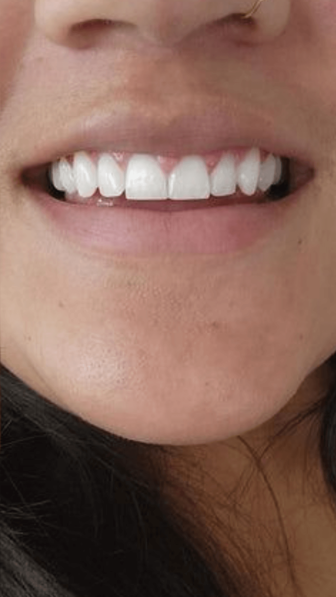 Clareamento dental resultado dentes brancos depois BH