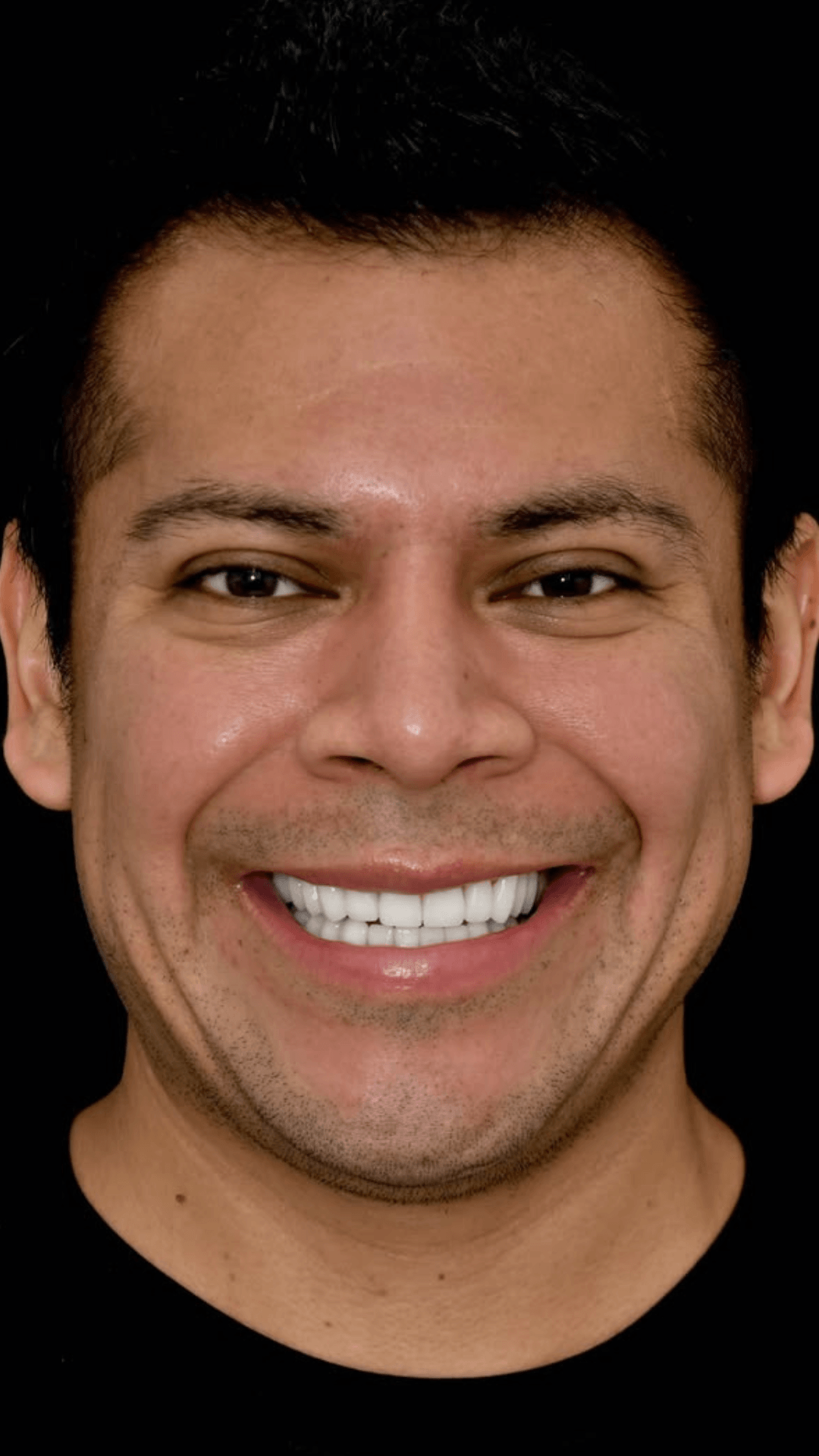 Facetas de porcelana sorriso harmonioso resultado BH