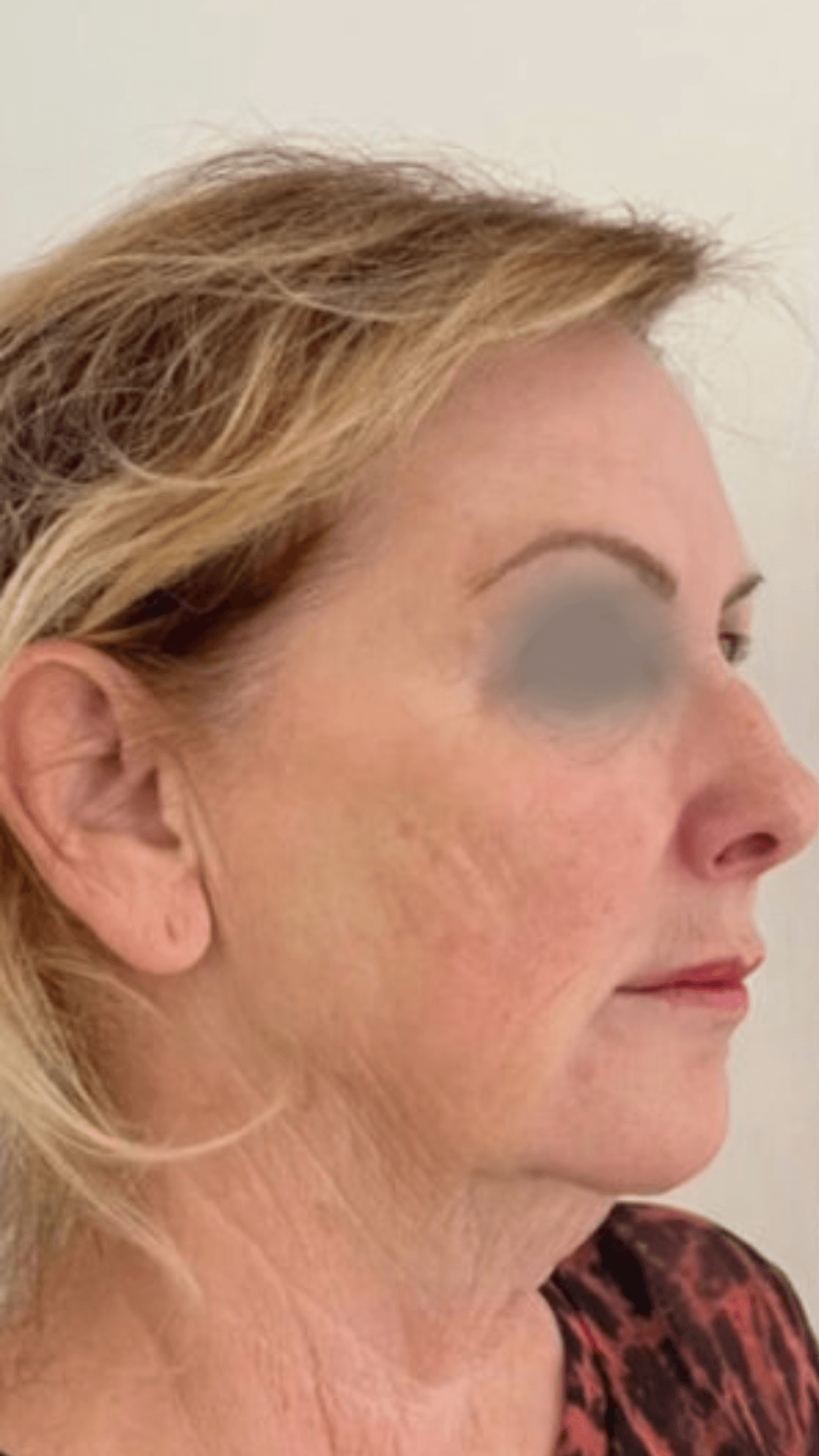 Fios de sustentação PDO (lifting facial sem cirurgia) antes — estética no Planalto, BH