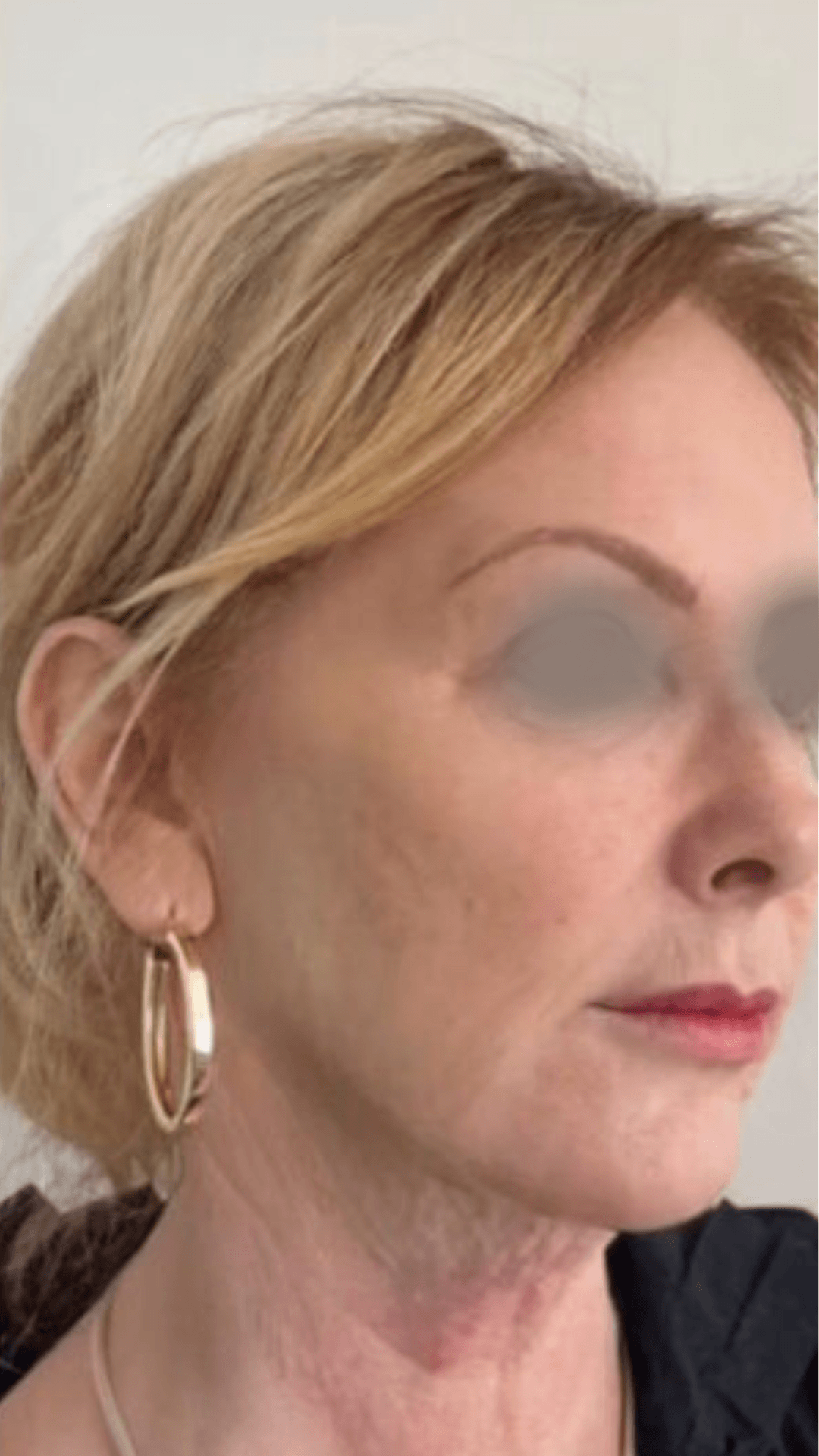 Fios de sustentação PDO (lifting facial sem cirurgia) depois — efeito lifting natural em BH