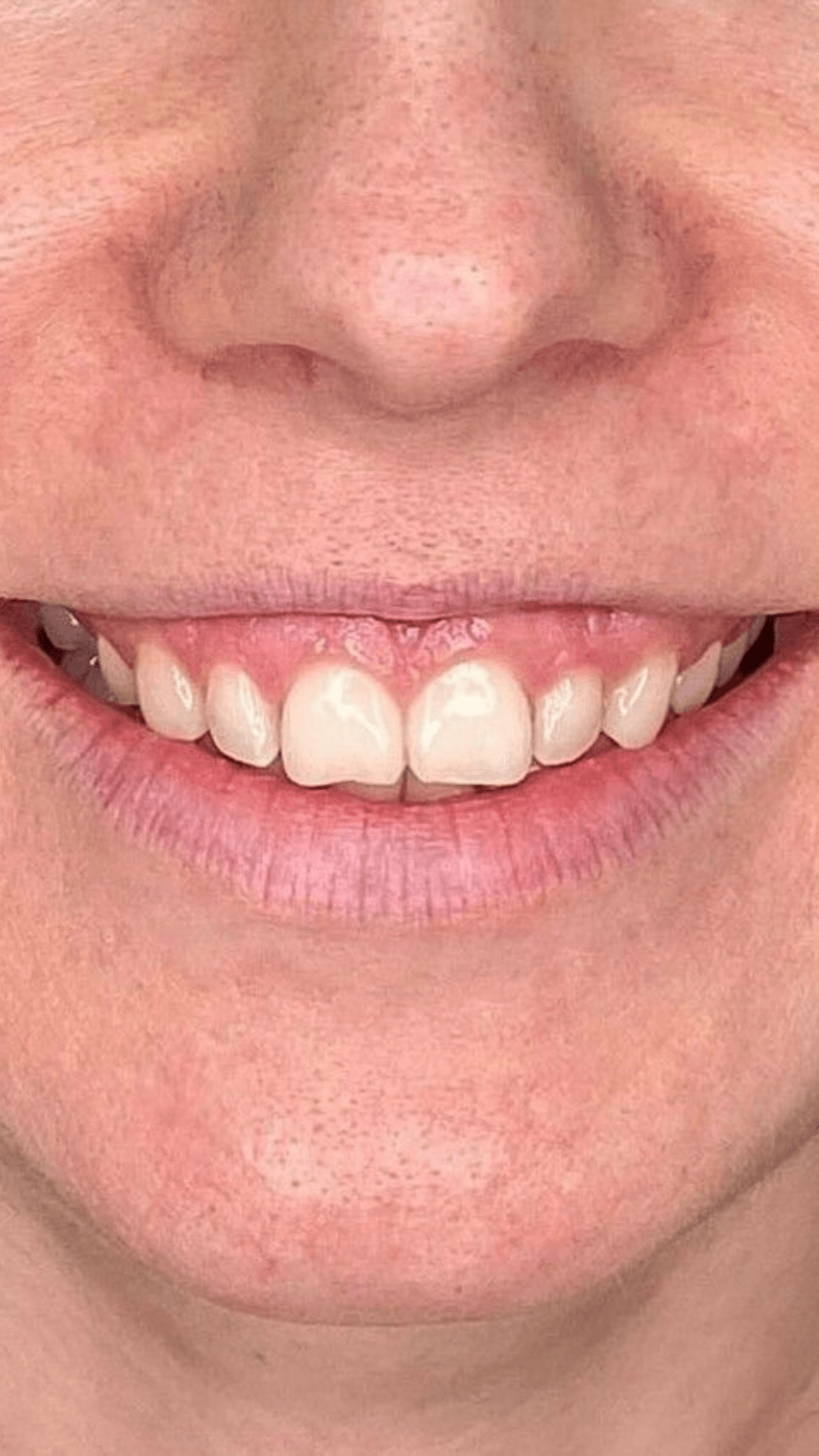 Harmonização do sorriso gengivoplastia antes Planalto BH