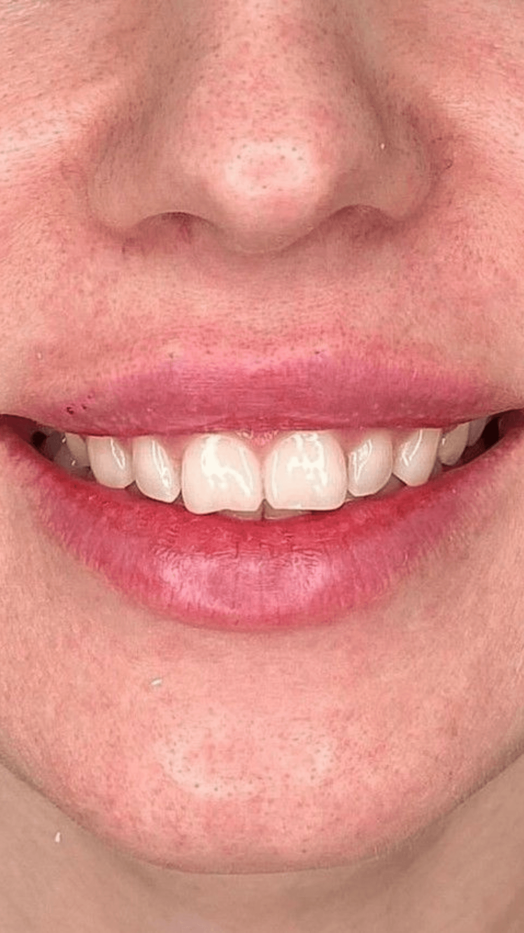 Harmonização do sorriso resultado antes e depois BH