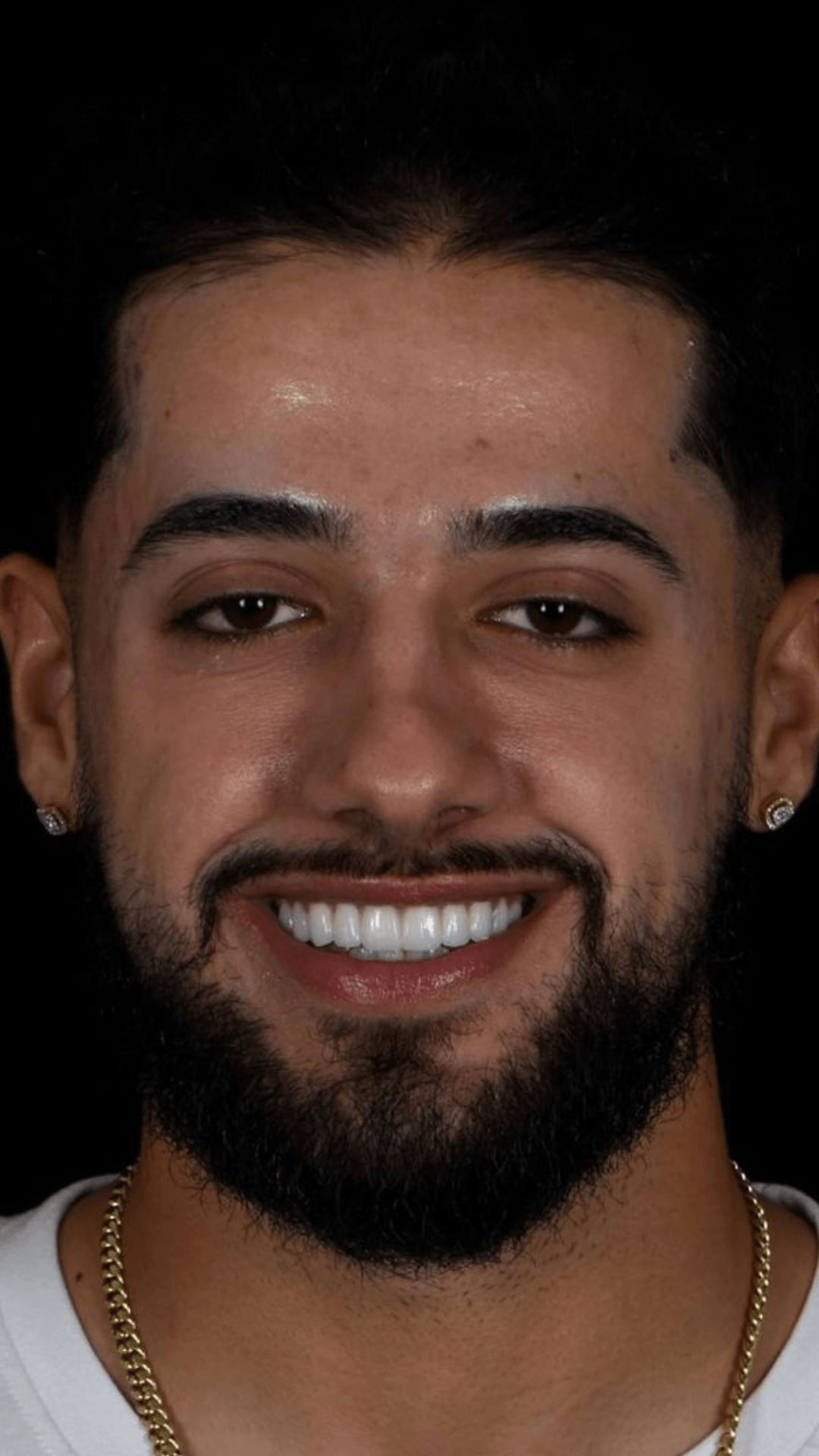 Lente de contato dental resultado depois BH