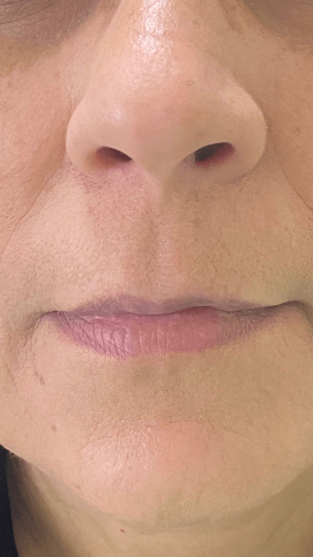 Preenchimento labial com ácido hialurônico antes — harmonização facial no Planalto, BH