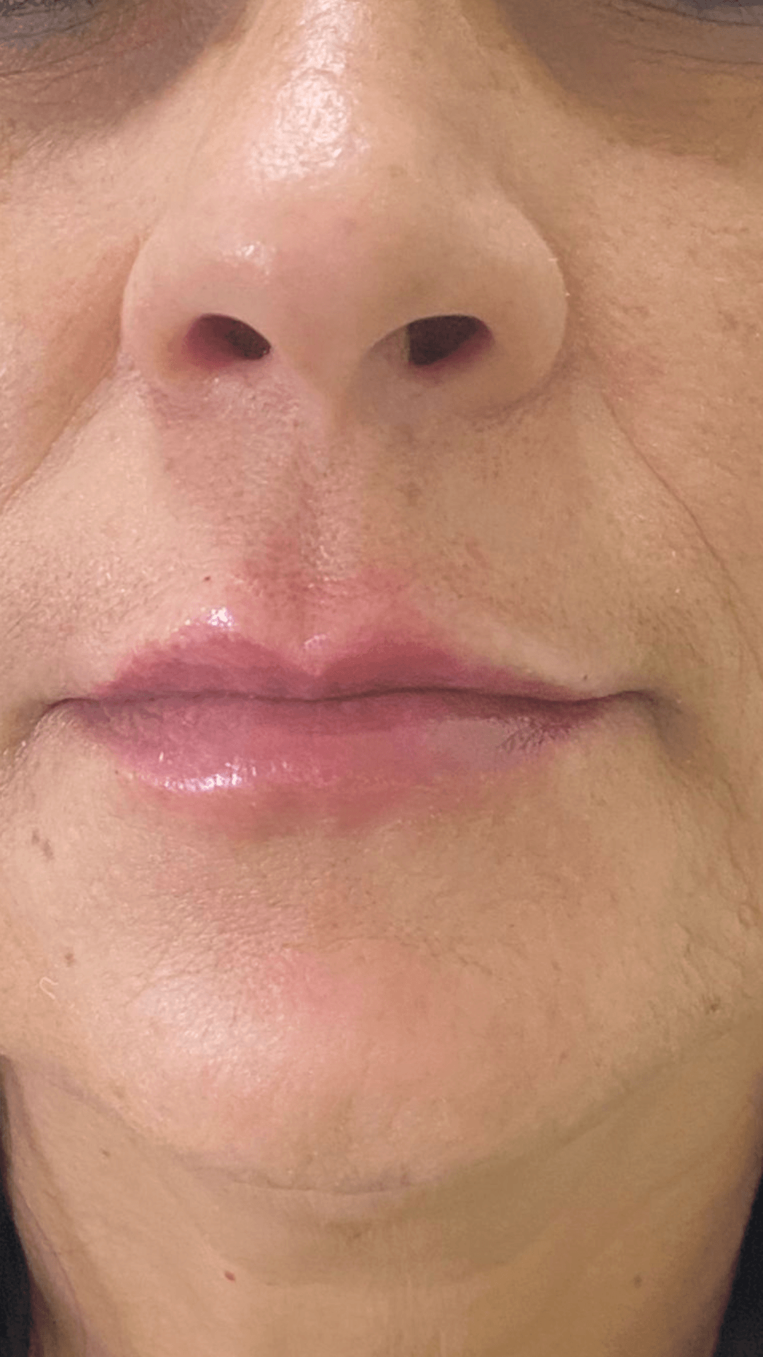 Preenchimento labial com ácido hialurônico depois — lábios naturais e volumizados em BH