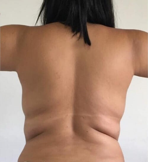 Redução de gordura localizada antes — estética corporal no Planalto, Belo Horizonte