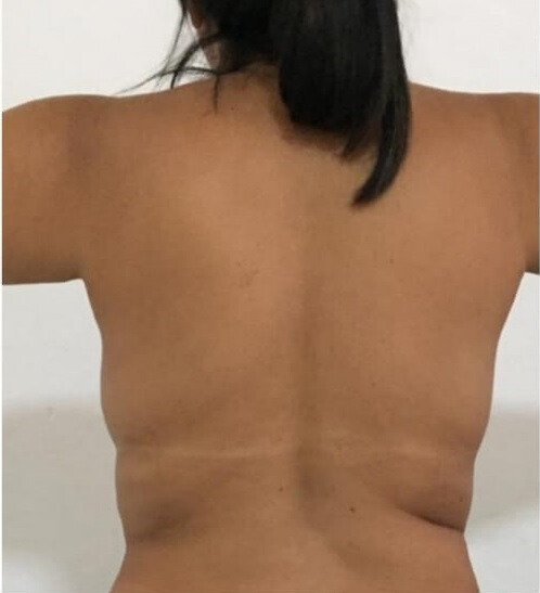 Redução de gordura localizada depois — resultado real de estética corporal em BH