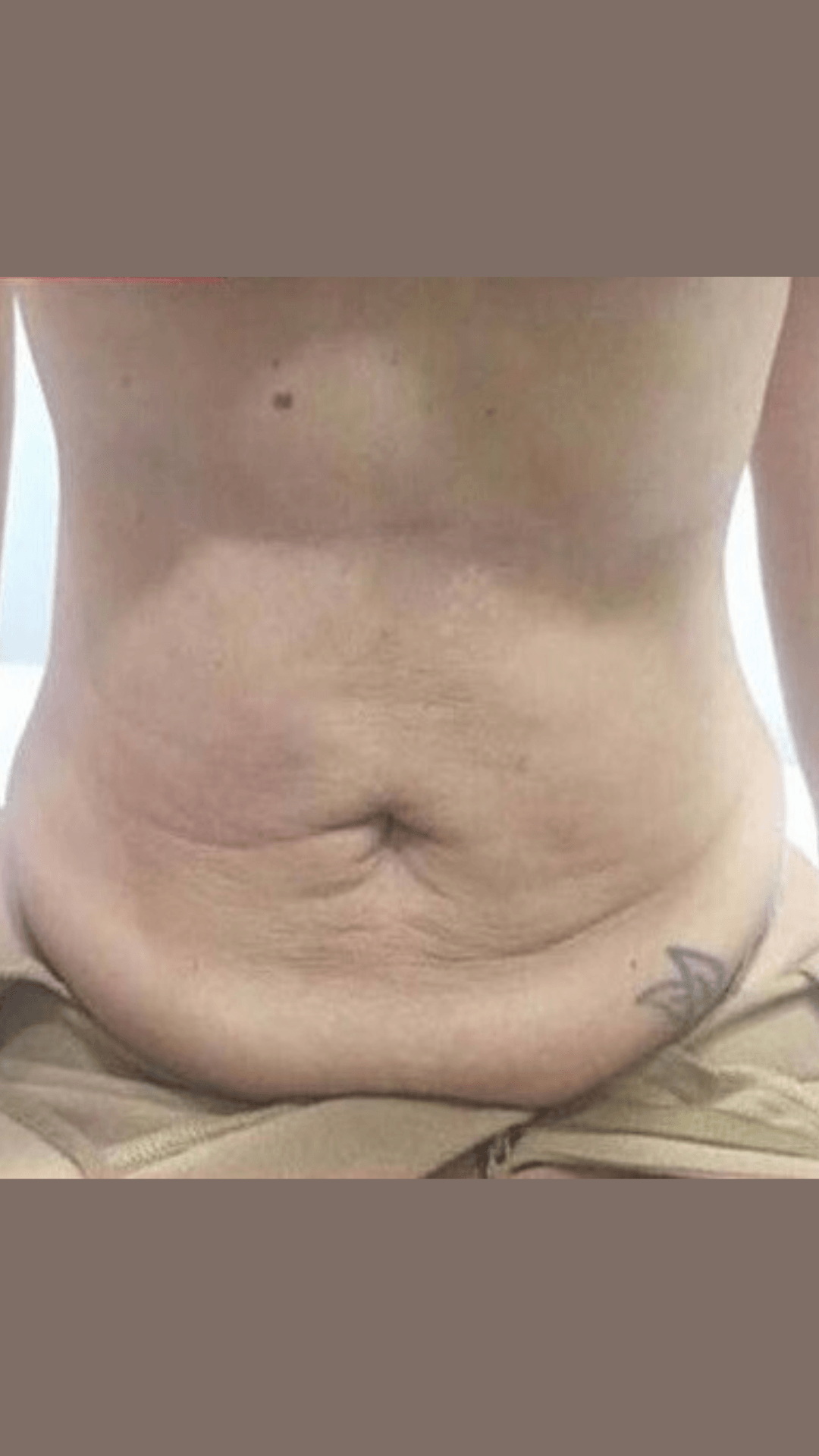 Tratamento de flacidez corporal antes — estética avançada no Planalto, Belo Horizonte