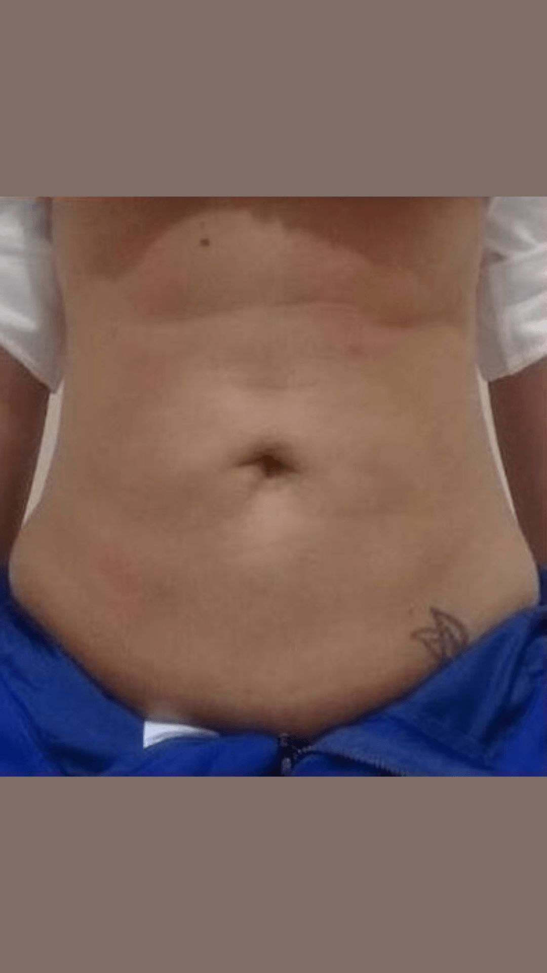 Tratamento de flacidez corporal depois — resultado real de firmeza da pele em BH